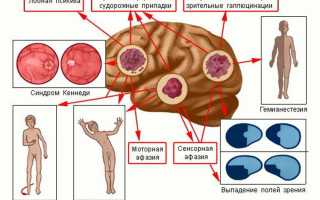 Симптомы и разновидности опухолей головного мозга: лечение и прогноз