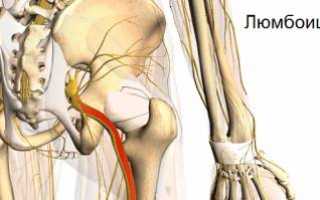 Люмбоишиалгия: что нужно знать о патологии