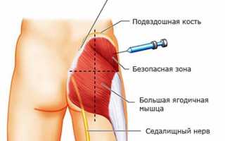 Показания, техника проведения и последствия блокады седалищного нерва