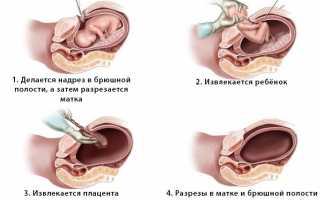 Как делают кесарево сечение. Подготовка и ход операции