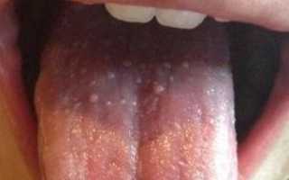 Пупырышки на языке ближе к гортани — причины и лечение