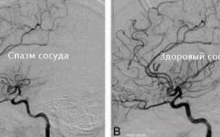 По каким признакам можно диагностировать спазм сосудов головного мозга и можно ли вылечить его в домашних условиях