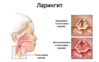 Антибиотики при ларингите — список самых эффективных препаратов