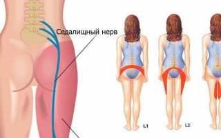 Симптомы защемления седалищного нерва и методики лечения ишиаса в домашних условиях