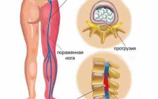 Почему происходит защемление нерва в ноге: причины и методы лечения