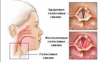 Ларингит – что это такое, симптомы, причины, как его лечить