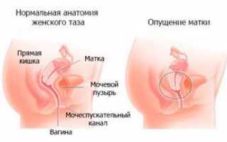 Что такое опущение матки