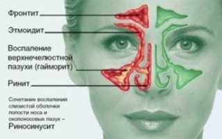 Синусит: характерные симптомы и лечение