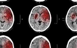 Характеристика заболевания обширный инсульт и его последствия