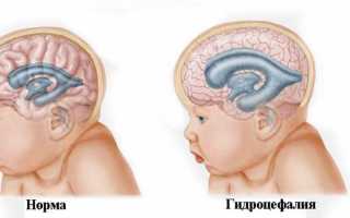 Почему возникает гидроцефалия головного мозга: ранняя диагностика, лечение и прогноз