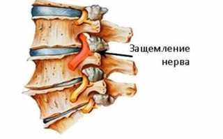 Какими симптомами проявляется защемление нерва в шейном отделе и можно ли его вылечить в домашних условиях