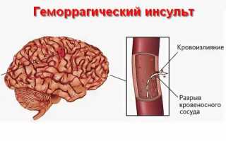 Насколько опасен геморрагический инсульт головного мозга