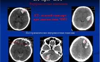 Для чего проводится компьютерная томография головного мозга и насколько безопасно это исследование