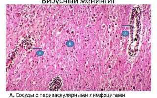 Вирусный менингит: причины, симптомы, методы лечения и профилактики опасной патологии