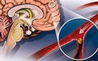 Прогноз для пациентов с нарушением мозгового кровообращения