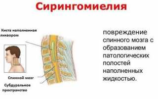 Сирингомиелия — можно ли обойтись без операции