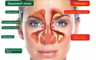 Какие капли в нос при синусите наиболее эффективные