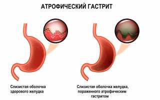 Что такое атрофический гастрит желудка