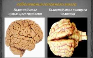 Алкогольная энцефалопатия как следствие алкогольной зависимости