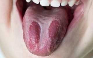 Болезни языка — какие бывают, симптомы, лечение