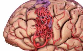 В каких случаях ставится диагноз «мальформация сосудов головного мозга» и чем опасно это состояние