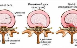 Причины, симптомы и методики лечения защемления нерва в пояснице