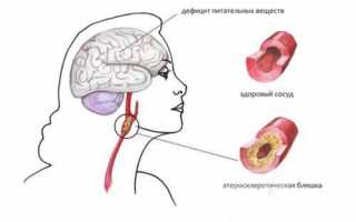 Почему возникает атеросклероз сосудов головного мозга