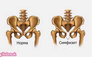 Симфизит при беременности: лечение, симптомы и причины