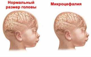 Дает ли возможность микроцефалия выжить ребенку