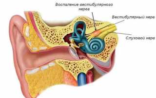 Вестибулярный нейронит — сколько длится головокружение