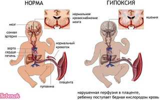 Гипоксия плода: признаки, симптомы, последствия, лечение