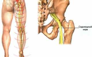 Опасно ли защемление нерва в тазобедренном суставе и чем его лечить