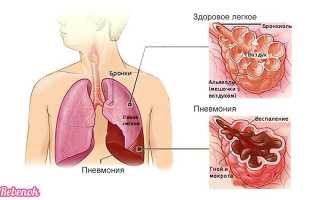 Пневмония у детей: признаки, симптомы, лечение, профилактика