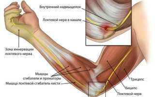 Что нужно знать при защемлении нерва в руке: методы лечения невропатии