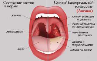 Как выглядит здоровое горло — как должно выглядеть у здорового человека
