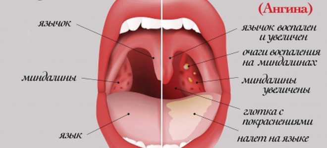 Как выглядит здоровое горло — как должно выглядеть у здорового человека