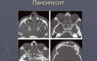 Что такое пансинусит и каким образом это лечить