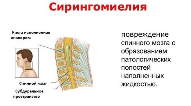 сирингомиелия - что это