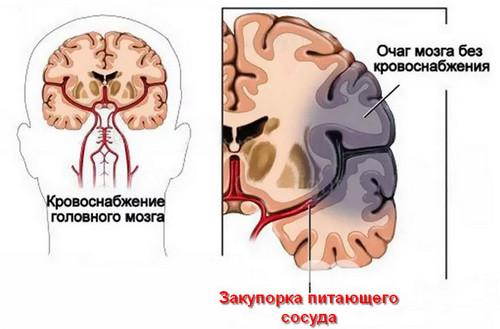 стадии развития ишемического инсульта