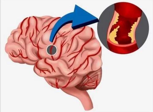 причины ишемического инсульта