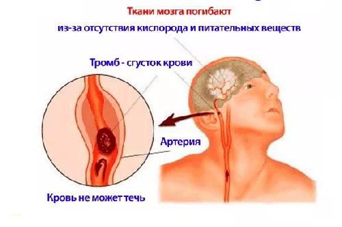 симптомы ишемического инсульта