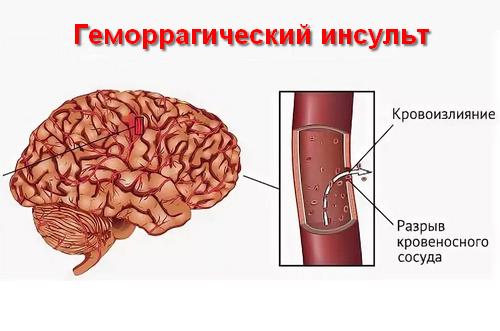 классификация геморрагических инсультов