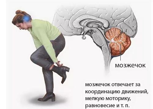 симптомы инсульта мозжечка