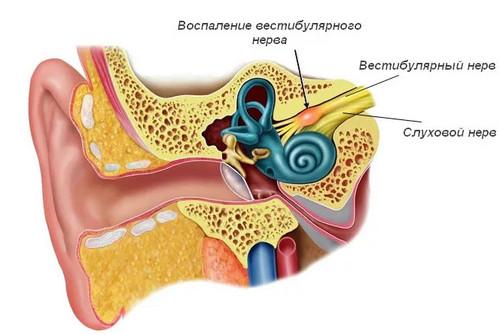 причины вестибулярного нейронита