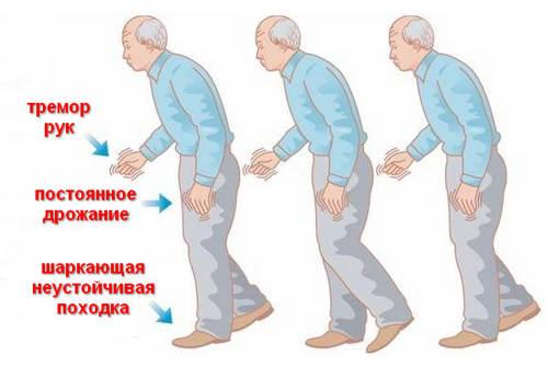 Эссенциальный тремор - симптомы