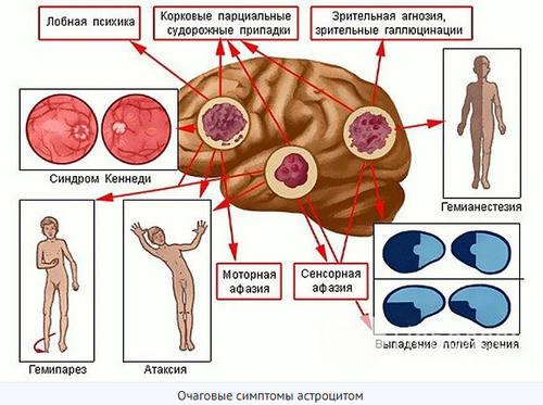 Астроцитома - симптомы