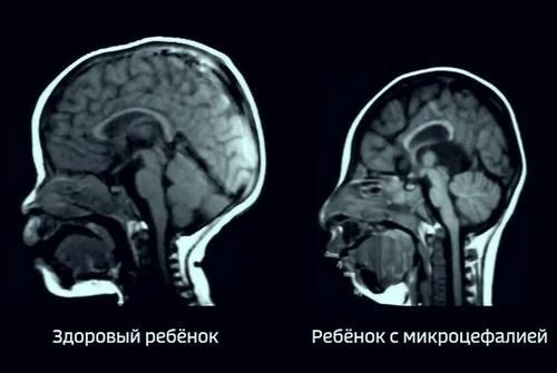 Чем отличается микроцефалия от гидроцефалии