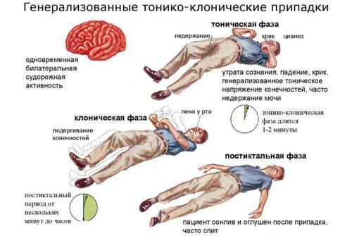 Генерализованные формы эпилепсии