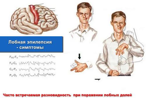 Лобная эпилепсия - симптомы