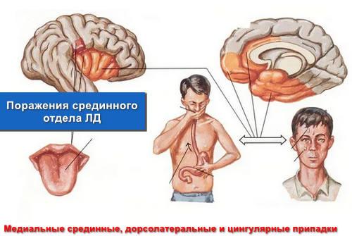 Поражения срединного отдела ЛД